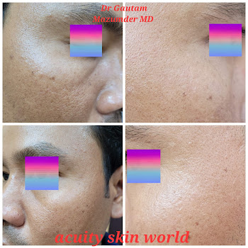 Acuity-skin-world-dr-gautam-mazumder-md-Dermatologist-doctors-Agartala-Tripura-1